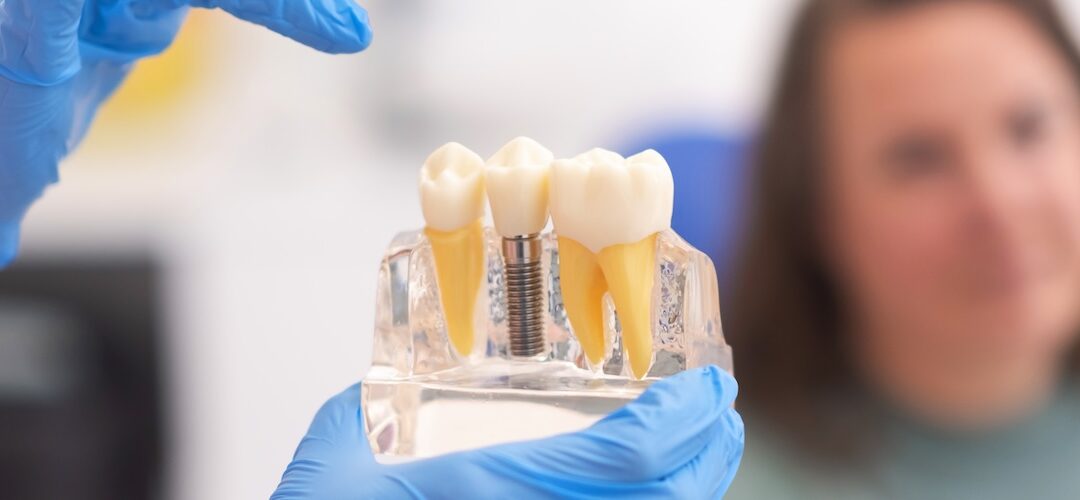 Advanced Dental Implant Solutions in Edgware