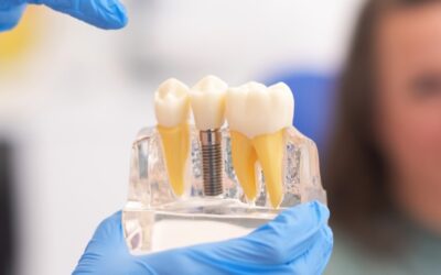 Advanced Dental Implant Solutions in Edgware